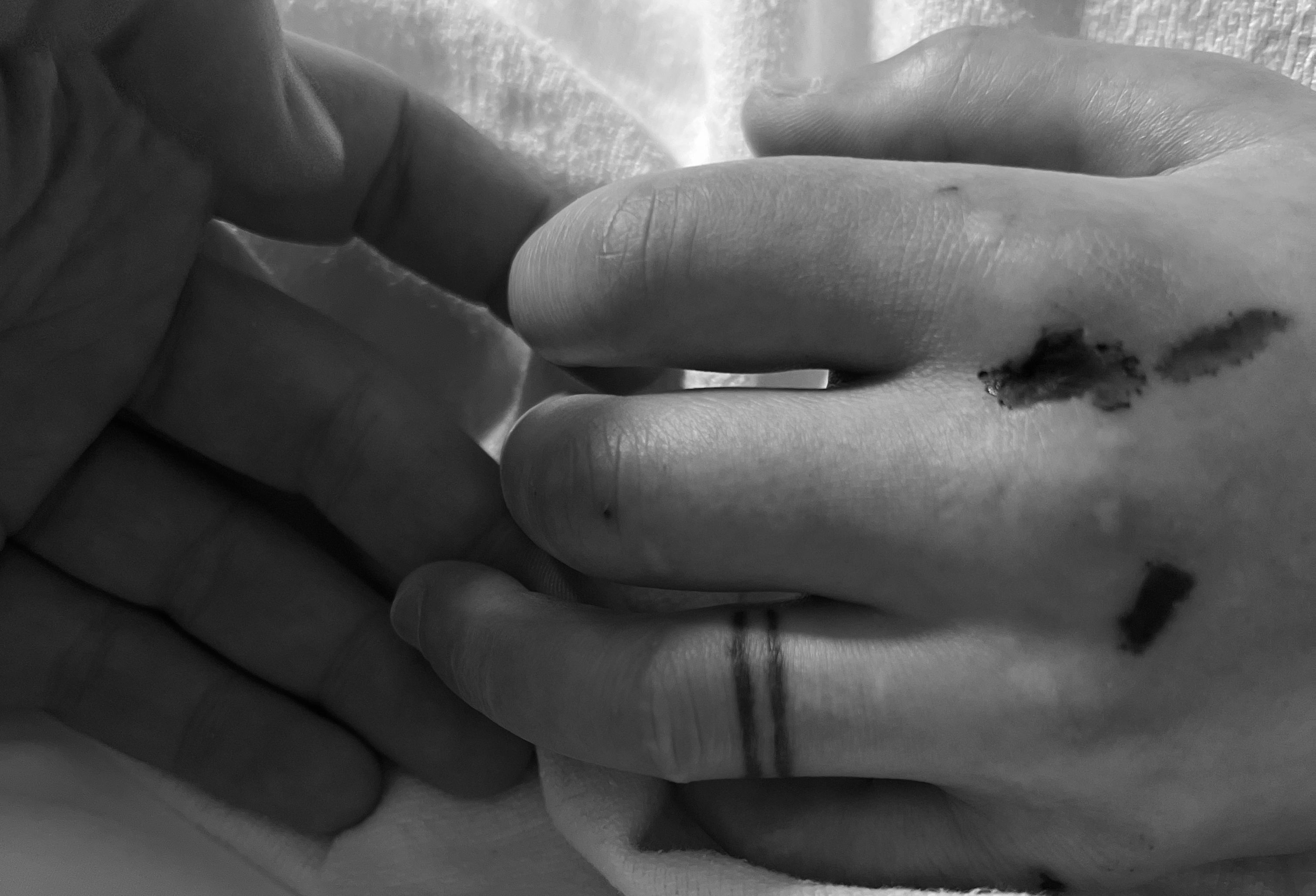 John holding Rachel’s hand in the ICU. John’s hand is on the left; Rachel’s is on the right.
