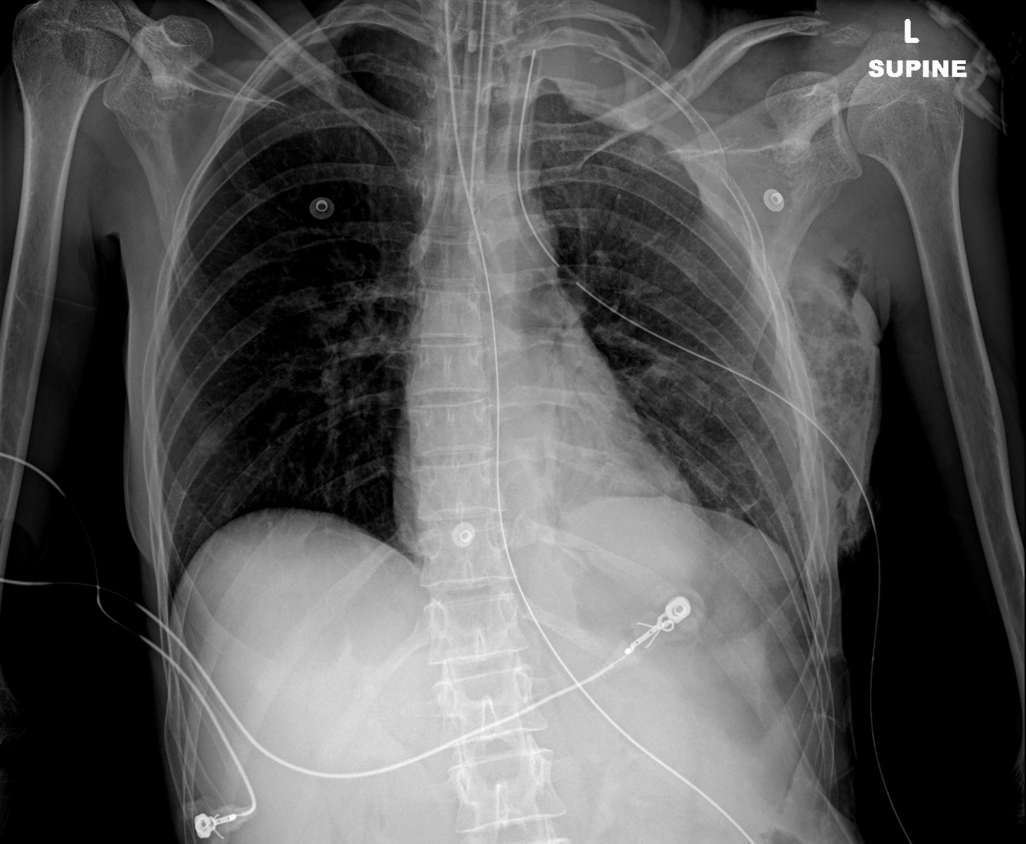 Rachel Foster's actual chest X-ray from OU Medical Center, supine AP view, November 2022. Shows multiple left-sided rib fractures and left lung opacification.